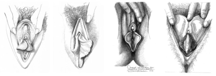 Форма половых губ - виды у женщин и девушек (фото)